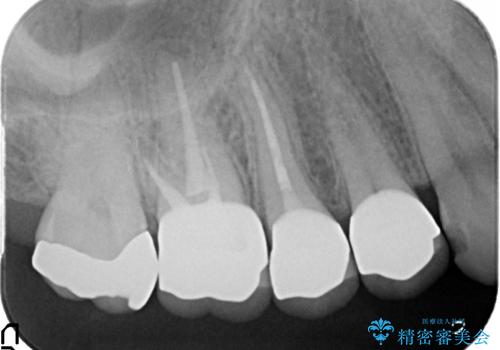 オールセラミッククラウン 咬合痛のある歯の治療の治療後