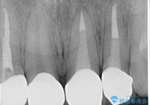 オールセラミッククラウン 前歯を綺麗に 神経が死んだ歯の再治療~補綴の治療後