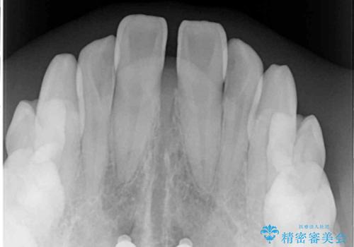 奥歯の反対咬合 上顎骨を拡大してインビザラインで矯正の治療中