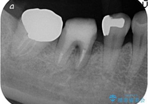 歯ぐきの腫れが治らない 石灰化した狭小根管治療の治療中
