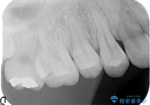 セラミックインレー 奥歯の治療の治療前