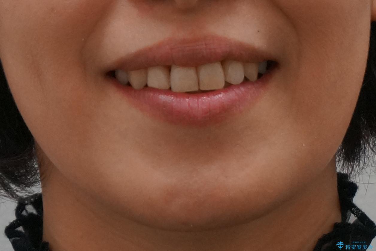 40代の矯正 八重歯を綺麗に の治療後(顔貌)