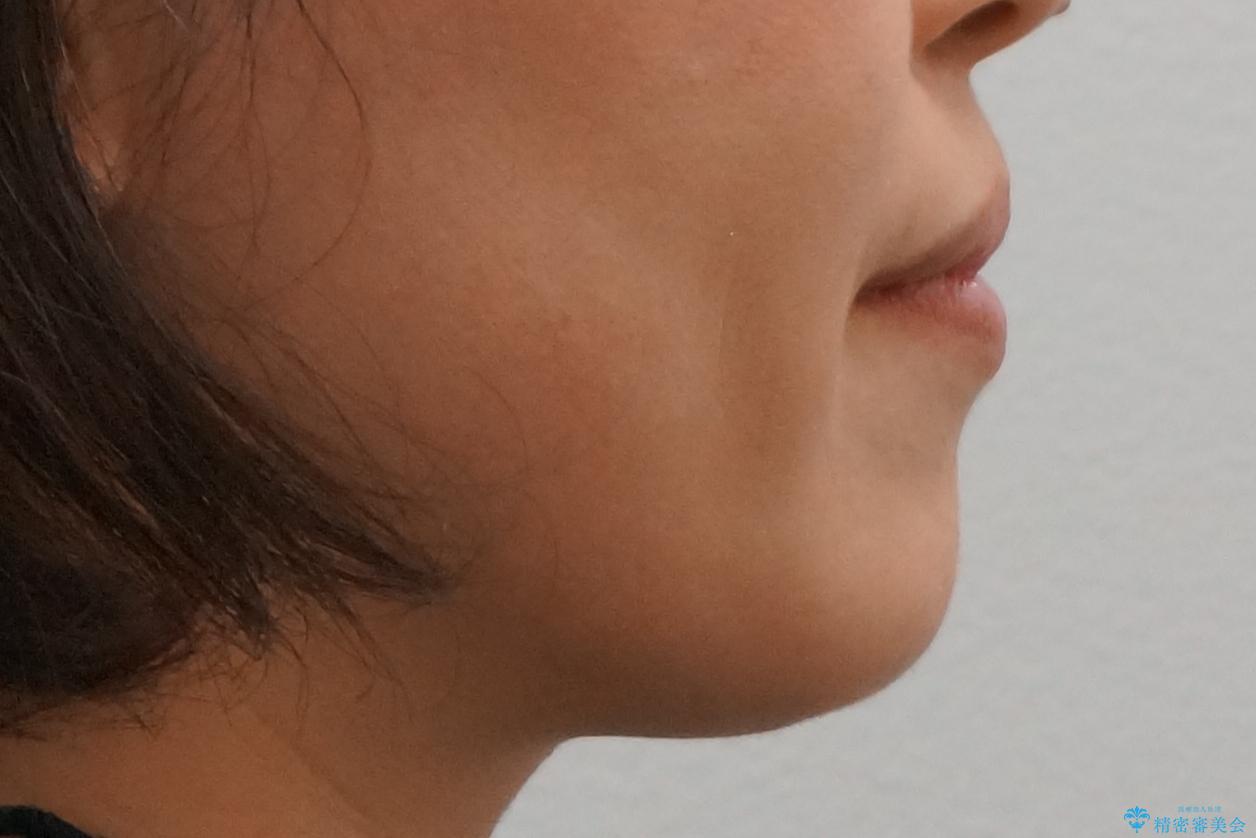 40代の矯正 八重歯を綺麗に の治療後(顔貌)