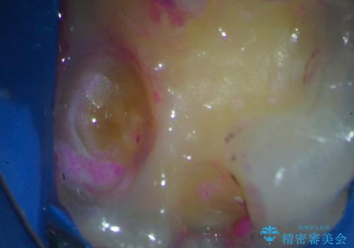 歯髄方向 歯肉方向へと深い 2種類の大きな虫歯の治療前