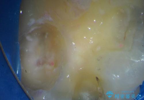 歯髄方向 歯肉方向へと深い 2種類の大きな虫歯の治療中