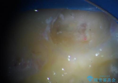 歯髄方向 歯肉方向へと深い 2種類の大きな虫歯の治療後