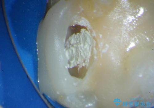 歯髄方向 歯肉方向へと深い 2種類の大きな虫歯の治療中