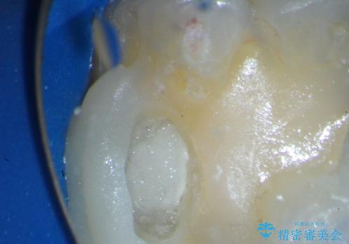 歯髄方向 歯肉方向へと深い 2種類の大きな虫歯の治療後