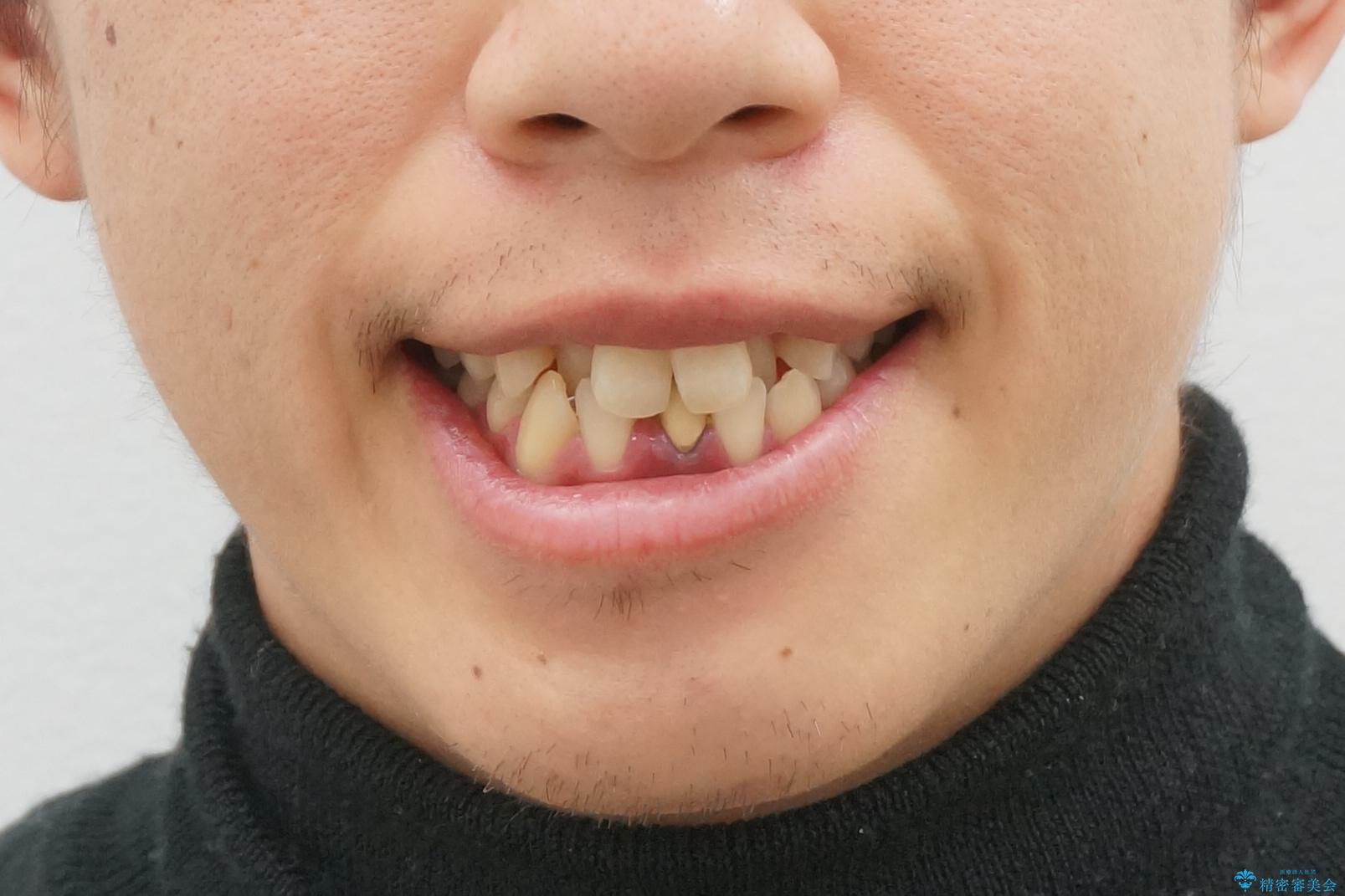 インビザライン矯正　神経のない歯をとって、全て天然歯に　の治療前（顔貌）