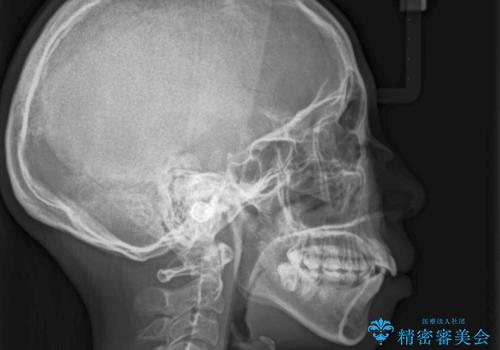 目立たない裏側矯正 抜歯矯正で口元を改善の治療前