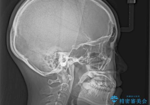 奥歯の反対咬合 上顎骨を拡大してインビザラインで矯正の治療前