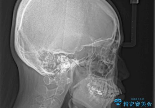 インビザラインで機能面に問題のある歯列を改善の治療前