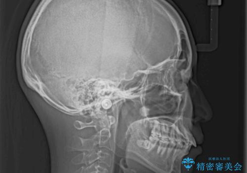 インビザラインによる軽度な出っ歯の矯正治療の治療前