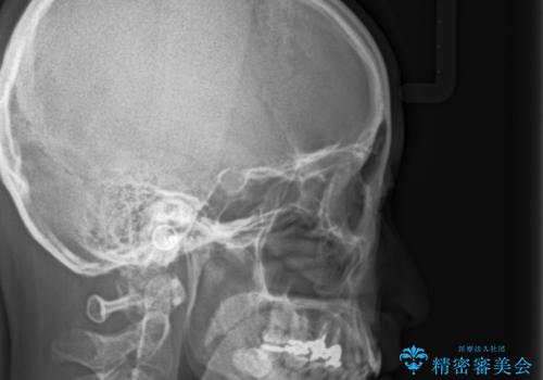 前歯の歯並びが気になる マウスピース矯正 30代女性の治療前