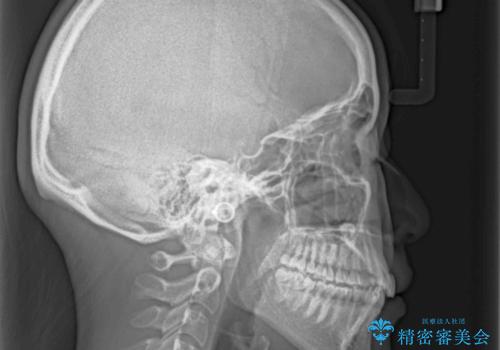 インビザライン矯正とインプラント治療と 総合歯科治療の治療前