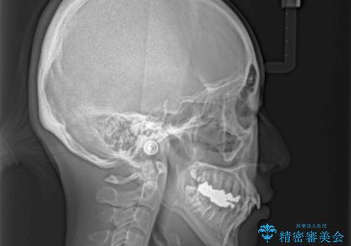 上顎骨拡大を併用したインビザライン矯正の治療前