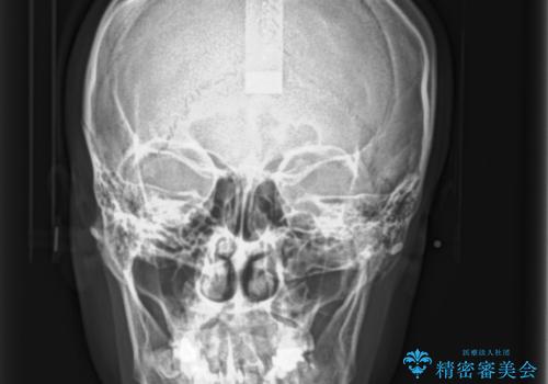 前歯の歯並びが気になる マウスピース矯正 30代女性の治療前