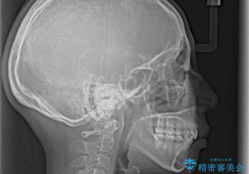 目立たない裏側矯正 抜歯矯正で口元を改善の治療後