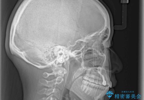 インビザライン矯正とインプラント治療と 総合歯科治療の治療後