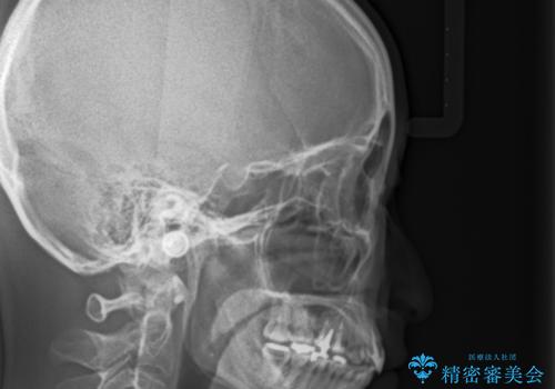 前歯の歯並びが気になる マウスピース矯正 30代女性の治療後