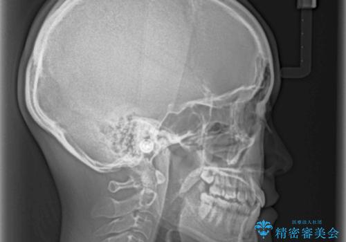 奥歯の反対咬合 上顎骨を拡大してインビザラインで矯正の治療後