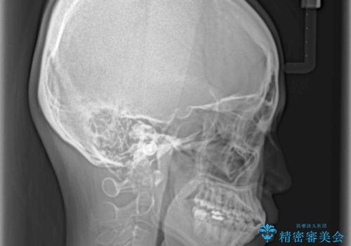 インビザラインで機能面に問題のある歯列を改善の治療後