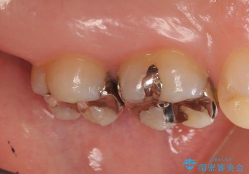 セラミックインレー 銀歯の下の縁下カリエス(歯茎より深い虫歯)の治療の治療前