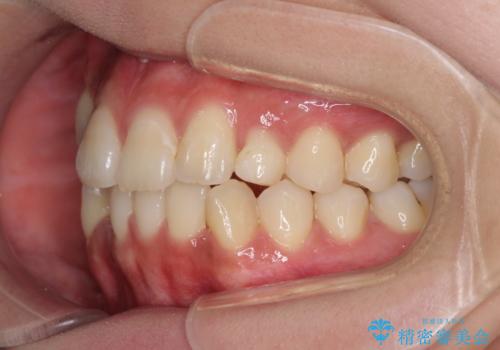 インビザライン矯正とインプラント治療と 総合歯科治療の治療中