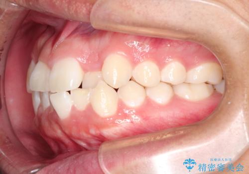 前歯のガタガタを目立たずきれいにしたい　インビザラインによる見えない矯正の治療前