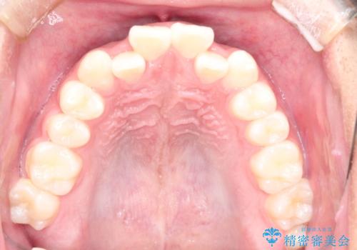 前歯のガタガタを目立たずきれいにしたい インビザラインによる見えない矯正の治療前