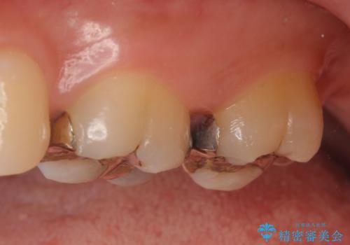 セラミックインレー 銀歯の下の縁下カリエス(歯茎より深い虫歯)の治療の治療前