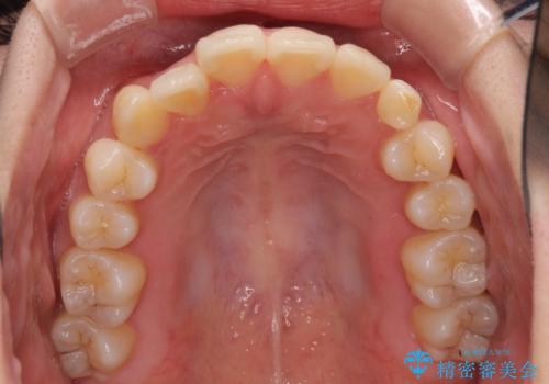 インビザライン矯正とインプラント治療と 総合歯科治療の治療中
