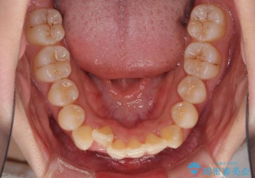 インビザライン矯正とインプラント治療と 総合歯科治療の治療中