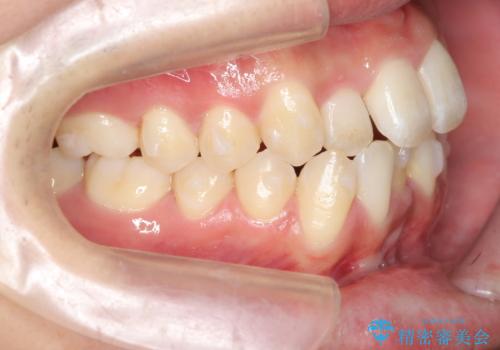 インビザライン矯正　神経のない歯をとって、全て天然歯に　の治療中