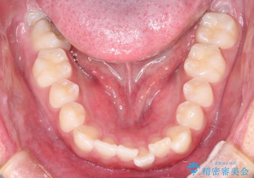 前歯のガタガタを目立たずきれいにしたい　インビザラインによる見えない矯正の治療前