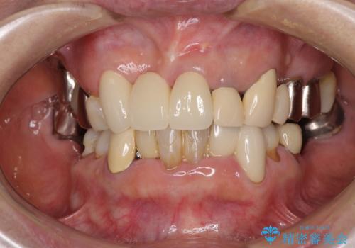 着色が著しい前歯のブリッジをオールセラミックできれいにの治療後