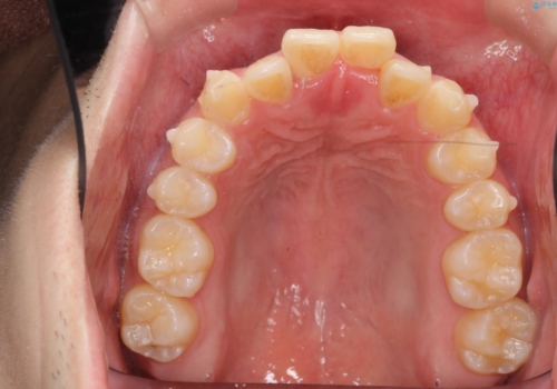 インビザライン矯正　神経のない歯をとって、全て天然歯に　の治療中