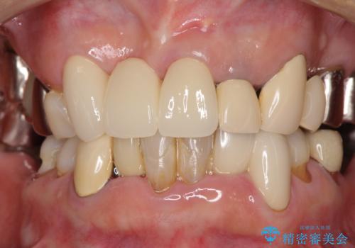 着色が著しい前歯のブリッジをオールセラミックできれいにの治療後