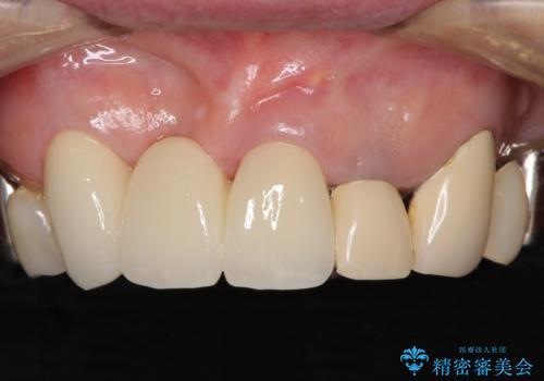 着色が著しい前歯のブリッジをオールセラミックできれいにの症例 治療後