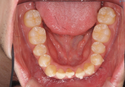 インビザライン矯正　神経のない歯をとって、全て天然歯に　の治療中