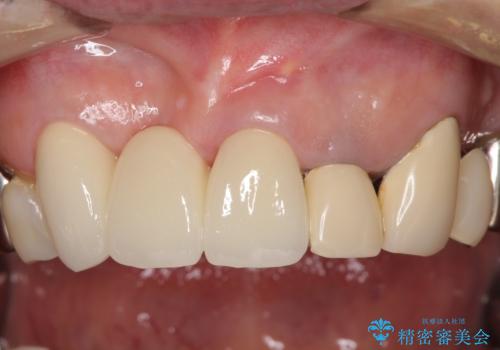 着色が著しい前歯のブリッジをオールセラミックできれいにの治療後