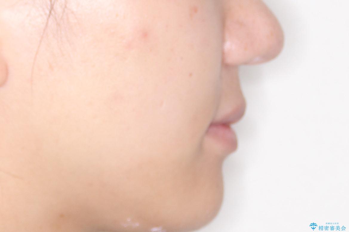 横顔をすっきりさせたい 下の前歯が1本少ない方の変則的な抜歯矯正の治療後(顔貌)