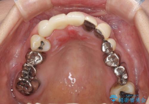 着色が著しい前歯のブリッジをオールセラミックできれいにの治療後