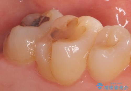 セラミックインレー 奥歯の治療の症例 治療前
