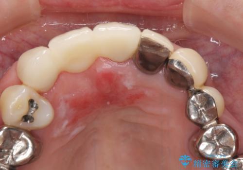 着色が著しい前歯のブリッジをオールセラミックできれいにの治療後