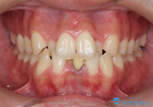 インビザライン矯正　神経のない歯をとって、全て天然歯に　の治療前