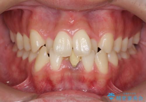 インビザライン矯正　神経のない歯をとって、全て天然歯に　の症例 治療前