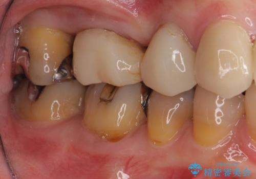 奥歯の歯槽骨が失われた　歯周外科処置後のセラミックブリッジの治療前