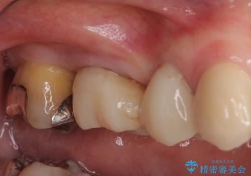 奥歯の歯槽骨が失われた　歯周外科処置後のセラミックブリッジの症例 治療前