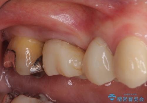 奥歯の歯槽骨が失われた　歯周外科処置後のセラミックブリッジの治療前